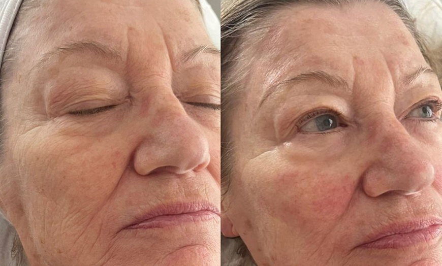 Image 2: RF Microneedling Treatment W/ Skin Nourishing Serum / Skin-Boosting 