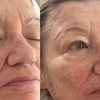 Image 2: RF Microneedling Treatment W/ Skin Nourishing Serum / Skin-Boosting 