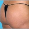 Image 1: Transform with Non-Surgical Brazilian Butt Lift Sessions