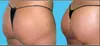 Experience Perfections Body Sculpt's Non-Invasive Brazilian Butt Lift and Cellulite Reduction up to 65%