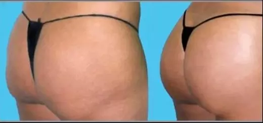 Experience Perfections Body Sculpt's Non-Invasive Brazilian Butt Lift and Cellulite Reduction up to 65% - Primary Image