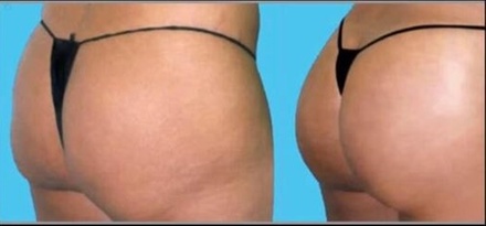One Non-Invasive Brazilian Butt Lift and Vacuum Cellulite-Reduction Treatment - Perfections Body Sculpt