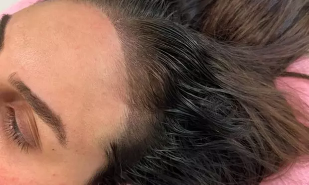 Get 1, 2, or 3 Scalp Micropigmentation Sessions, or Touch Up Only at Peladi Cosmetics - Primary Image