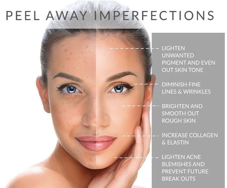 Revitalize Your Skin with a Chemical Peel and Aftercare