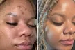 Millennium Day Spa Exclusive: Cool Jet Plasma Facial Packages — Up to 72% Savings - Second Medium