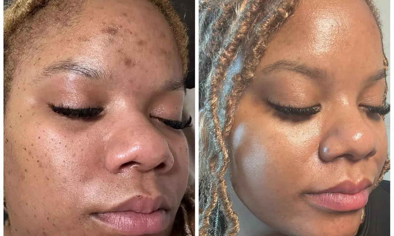 Get 1,3, or 6 Treatment Cool Jet Plasma Full Face
