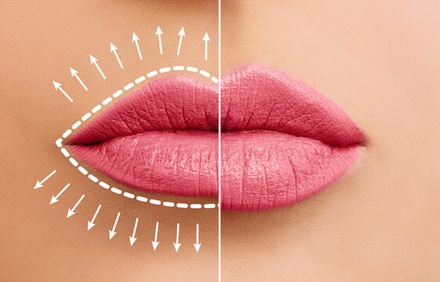 Half Syringe of Dermal Filler - Intoxicated Injectables