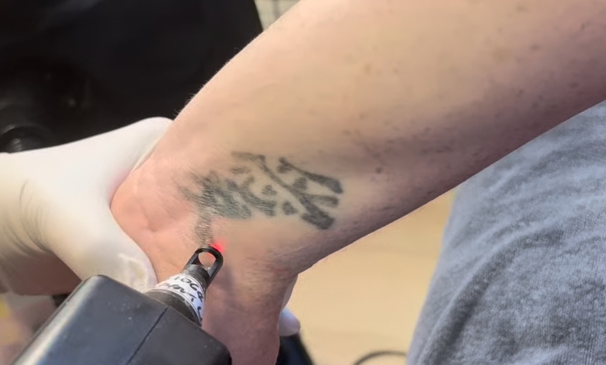 Image 2: Tattoo Removal w/ Numb Cream & Laser Removal - Small, Medium or Large 