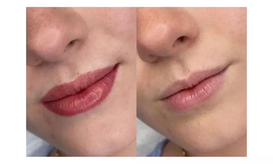 Image 2: Up to 40% Off on Lip Enhancement at Blushed and Body Cosmetics