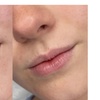 Image 2: Up to 40% Off on Lip Enhancement at Blushed and Body Cosmetics