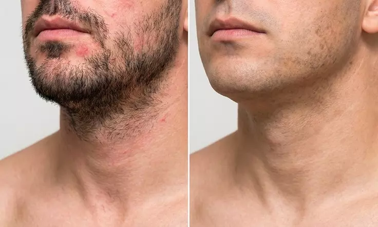 Stoppelvrij door het leven: 3 of 6 keer laserontharingsbehandelingen