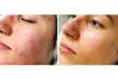 Zena Aesthetics Offers One or Three Polynucleotide HA Microneedling Treatment (Up to 40% Off) - Second Medium