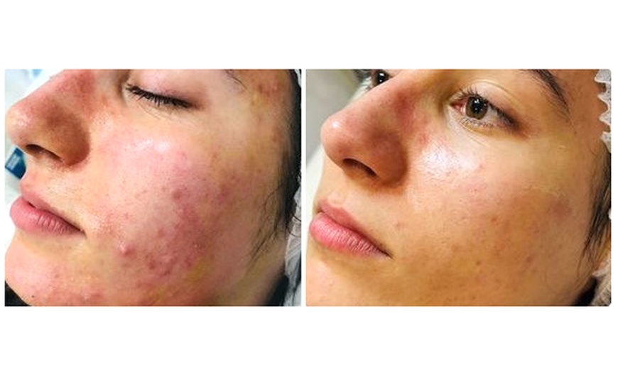 Image 2: Revitalize with One or Three Polynucleotide HA Microneedling Treatment