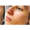 Image 2: Revitalize with One or Three Polynucleotide HA Microneedling Treatment