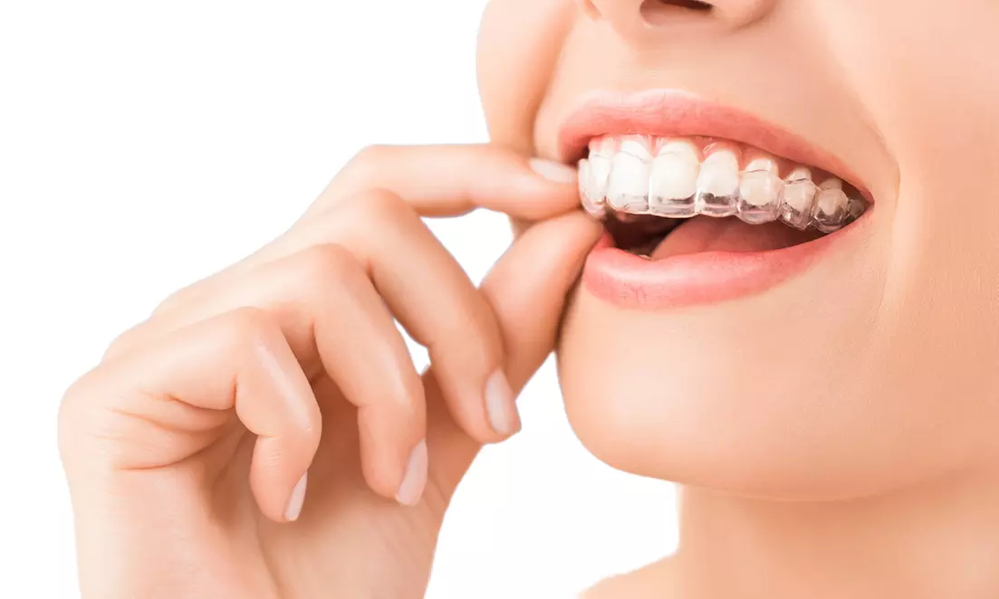 Brackets con revisiones, estudio completo u opción  de escaneo 3D