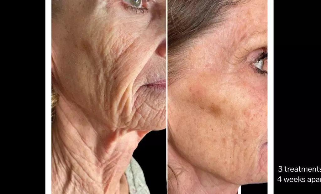 Morpheus8 Non-surgical Tightening - Allure Passions Aesthetic Clinic