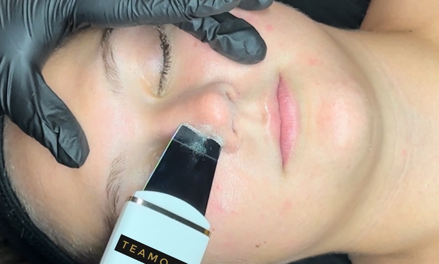 Image 3: HIFU Treatment on Full Face or One Area of Face at TEAMO&T