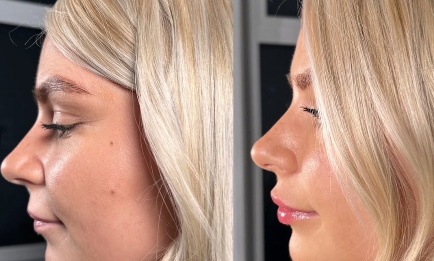 Image 9: Revitalize with 1ml, 2ml, or 3ml Dermal Fillers for Cheek, Jaw or Chin