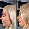 Image 9: Revitalize with 1ml, 2ml, or 3ml Dermal Fillers for Cheek, Jaw or Chin