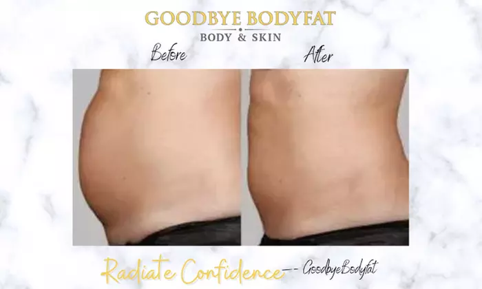 Radio-Frequency Lypolysis Sessions at Goodbye BodyFat