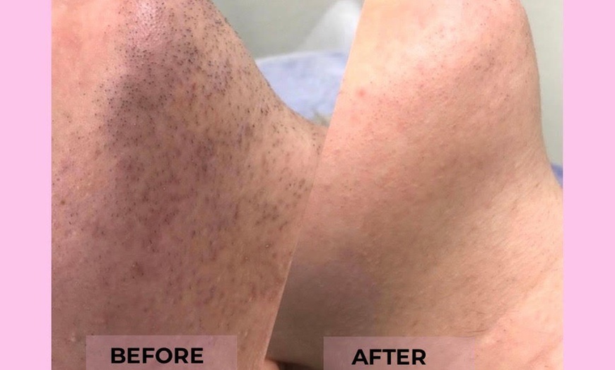 Image 1: Try the only FDA-Approved Permanent Electrolysis Hair Removal