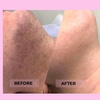 Image 1: Ditch the razor! Try the only FDA-Approved Permanent Electrolysis Hair Removal