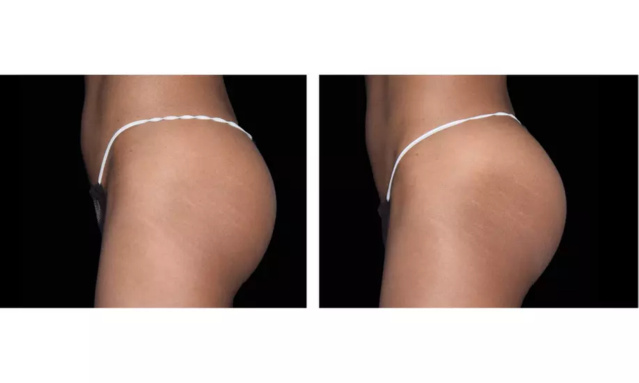 Up to 56% Off on Electrical Muscle Stimulation at TS3 Hair Salon And Spa