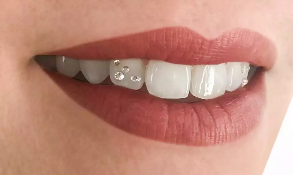 Sparkling Smile with Swarovski  Tooth Gem Placement for 1 2 or 3 Teeth