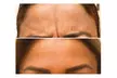 Up to 40% Off on Injection - Botox at Vita Medspa - Oviedo - Second Medium