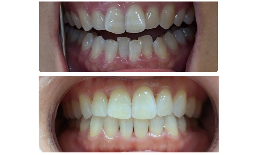 Image 2: Clear Aligner Teeth Straightening with Full Invisalign Package