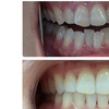 Image 2: Clear Aligner Teeth Straightening with Full Invisalign Package