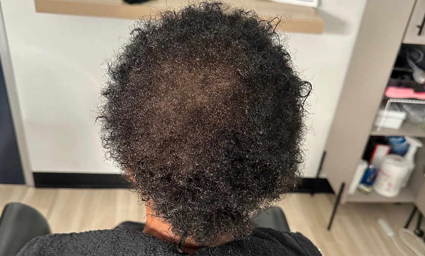 Image 4: Scalp Analysis and Hair Restoration Consultations