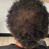 Image 4: Scalp Analysis and Hair Restoration Consultations