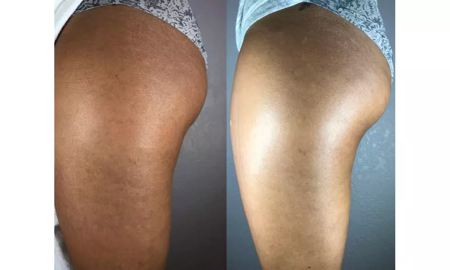 Tone with Five Sessions of Body Sculpting - Small or Large Area