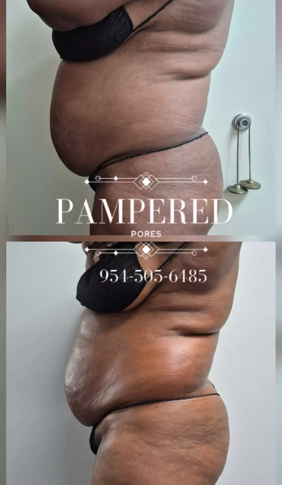 Get 1, 3, or 6(60 Min) Ultrasonic Cavitation, RF & Laser Lipo Sessions