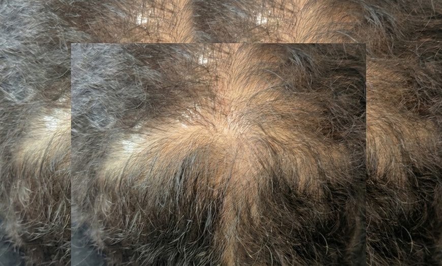 Image 4: Hair Restoration Scalp Micropigmentation : 1 Spot/Partial or Full Head