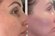 Rejuvenate with One, Three, or Six 60-Min IPL Facial Sessions at DALA Med Spa and Save Up to 55% Off on - Second Medium