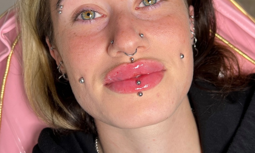 Image 4: 1 or 2 ML For Lip or Chin or Cheek with Consultation