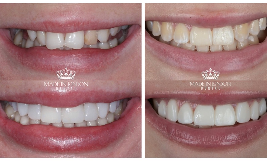 Image 6: Up to 66% Off on Teeth Whitening at Made in London Dental