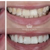 Image 6: Up to 66% Off on Teeth Whitening at Made in London Dental