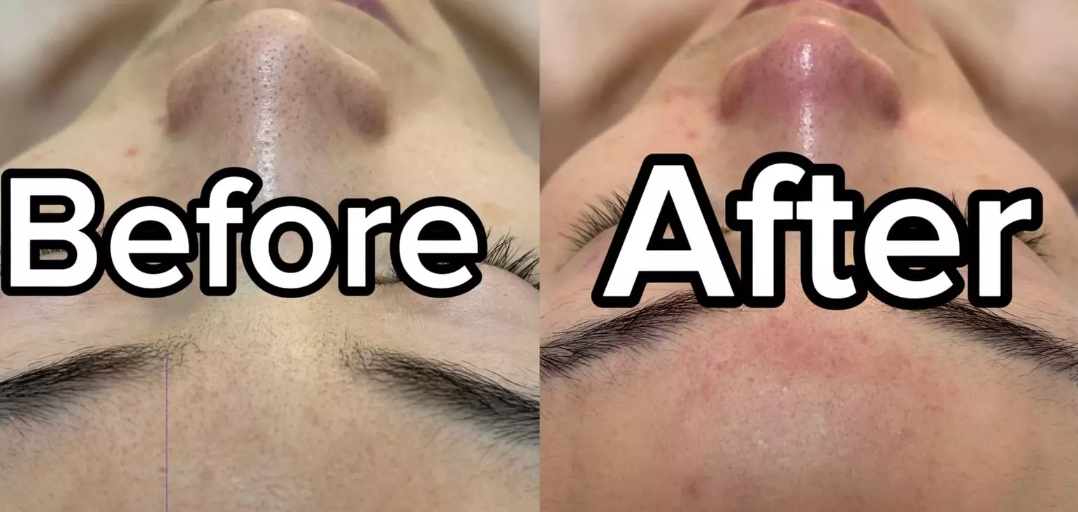 1, 2 or 3 Sessions of Deep Cleaning Facial & Shoulder & Neck Massage