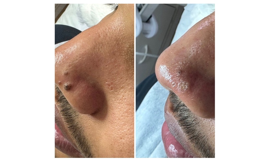 Image 4: Remove Up To 10 Skin Tags, Moles, Warts Or Milia Up To 2mm