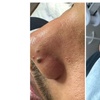 Image 4: Remove Up To 10 Skin Tags, Moles, Warts Or Milia Up To 2mm