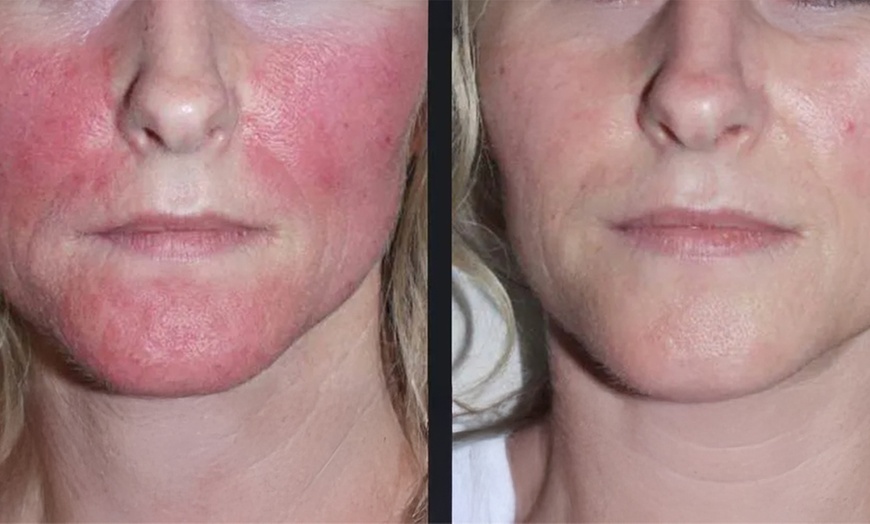 Image 4: Revitalize Your Skin With Nordlys IPL Treatments For Face And Body