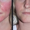 Image 4: Revitalize Your Skin With Nordlys IPL Treatments For Face And Body