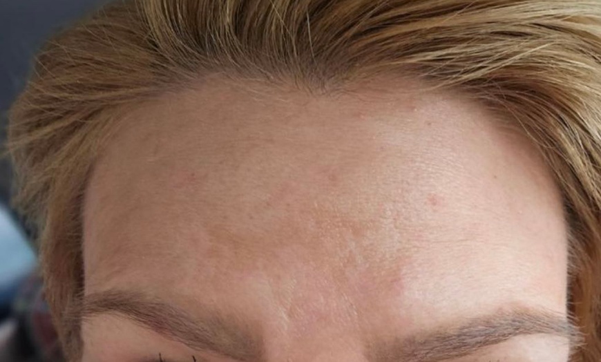 Image 3: Lift and Rejuvenate with HIFU Face, Neck, Chin Lift and More!