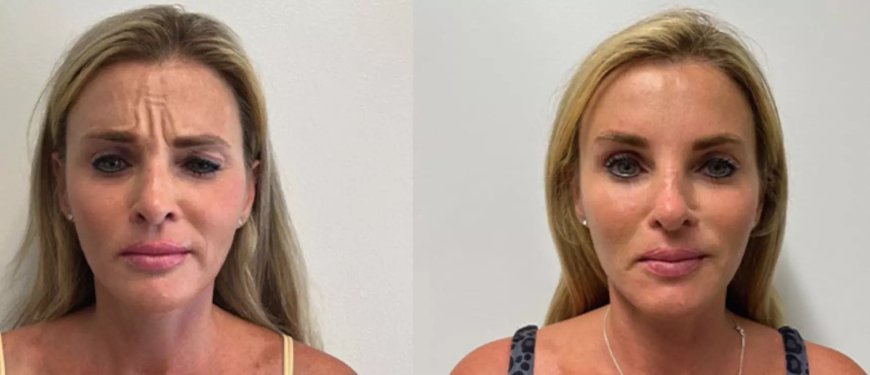 Freeze Time & Glow On: Custom Daxxify Treatments for Every Look!