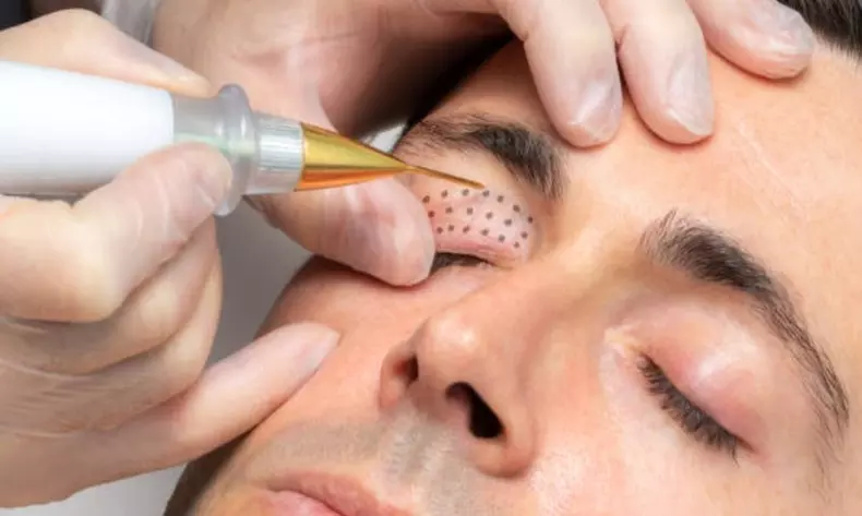 1 o 2 sesiones de fibroblast con plasma pen facial completo para 1