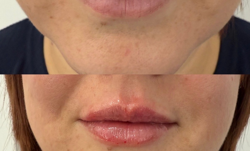Image 2: Dermal Filler: Choice of Areas for Enhanced Appearance
