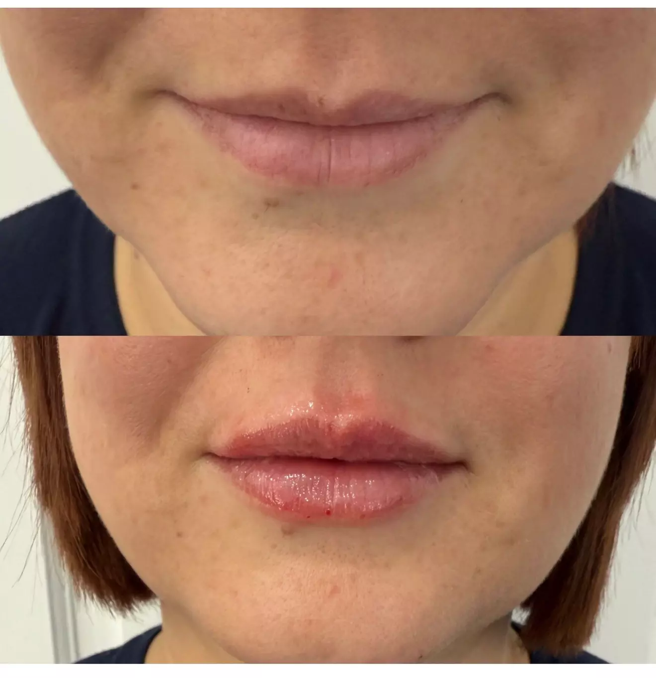 Dermal Filler: 0.5ml or 1ml for Targeted Areas to Enhance Your Natural Beauty (Up to 75% Off) At RGN Aesthetics - Second Medium